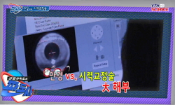안경 vs 시력교정술